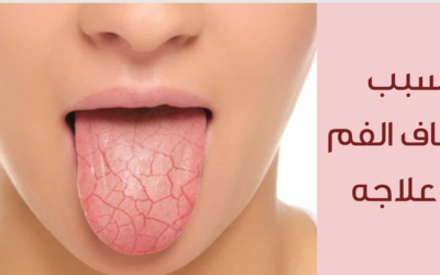 وش أسوي: جفاف الفم