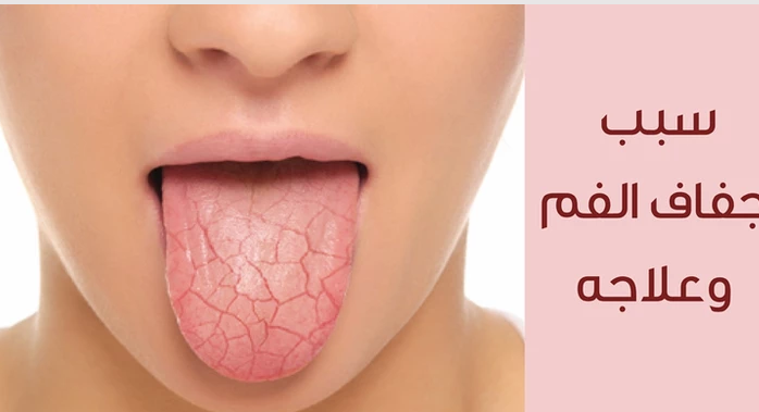 وش أسوي: جفاف الفم