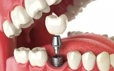 وش أسوي: جراحة الأسنان