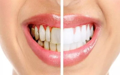 وش أسوي: تسوس الأسنان