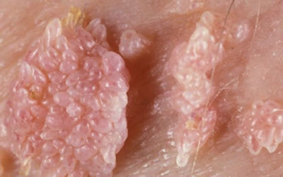 علاج الثالول التناسلي عند الرجال