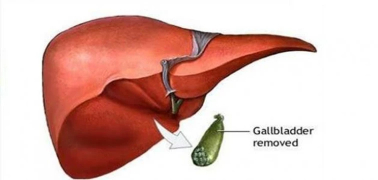 وش أسوي: استئصال المرارة