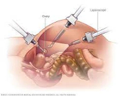 وش أسوي: جراحة استئصال المبايض