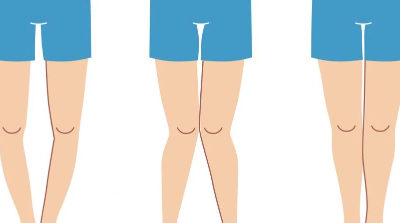 وش أسوي: الكساح