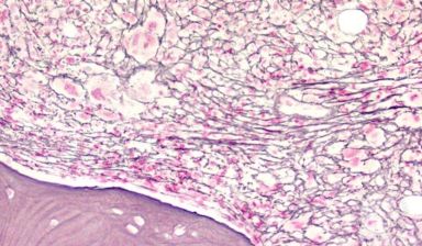 وش أسوي: التليف النقوي