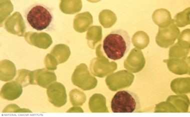 وش أسوي: ابيضاض دم مشعر الخلايا