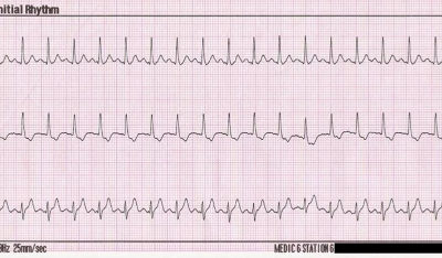 وش أسوي: تسرع القلب