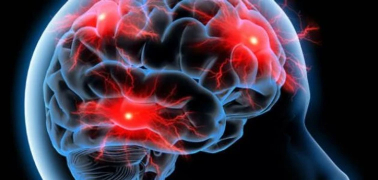 وش اسوي : مرض الصرع