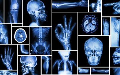 وش اسوي : الأشعة السينية