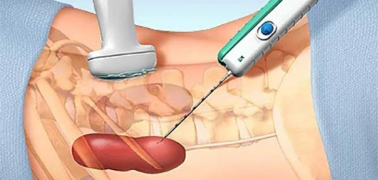 وش أسوي: خزعة نخاع العظم