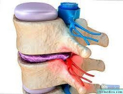 وش أسوي: التضيق الشوكي