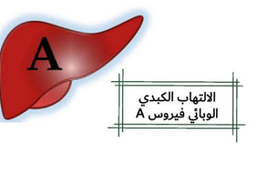 وش أسوي: التهاب الكبد A