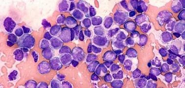 وش أسوي: ابيضاض الدم النقوي المزمن