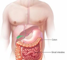 وش أسوي: الانسداد المعوي