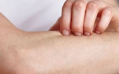 7أشياء يجب أن تعرفها عن لدغات الحشرات