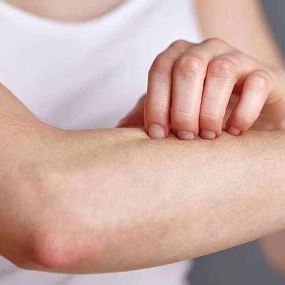 7أشياء يجب أن تعرفها عن لدغات الحشرات