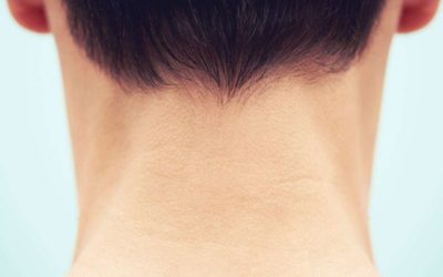 كيفية علاج التينيا فى الرقبة