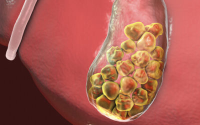 حصى المرارة