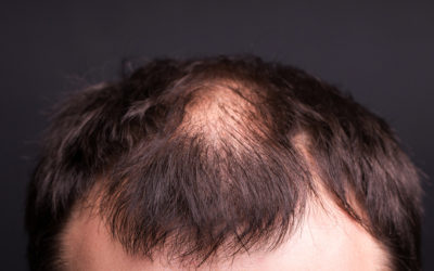 علاج الصلع المبكر وأسباب حدوثه