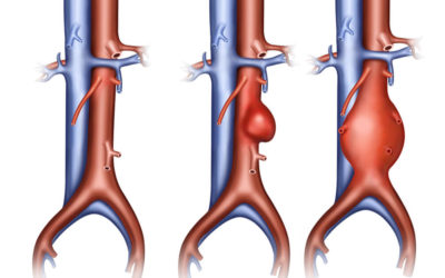 أعراض الشريان الأبهر