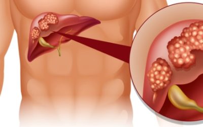 أعراض سرطان الكبد الحميد