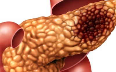 سرطان البنكرياس