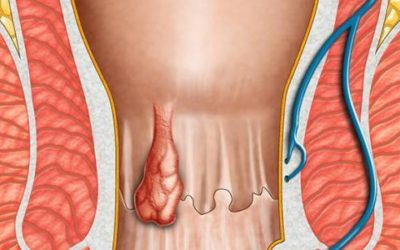 أسباب البواسير
