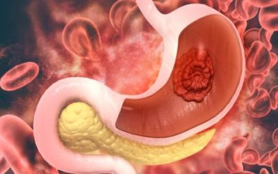 أعراض سرطان المعدة