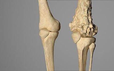 سرطان العظام