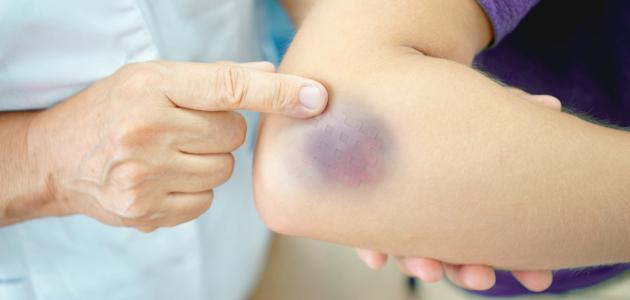 طرق علاج الكدمات في الجسم