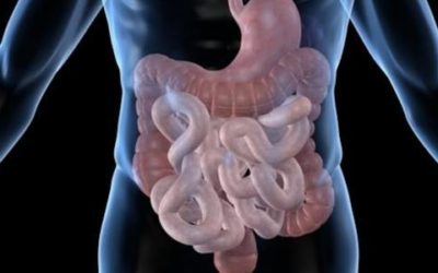 متلازمة الأمعاء القصيرة